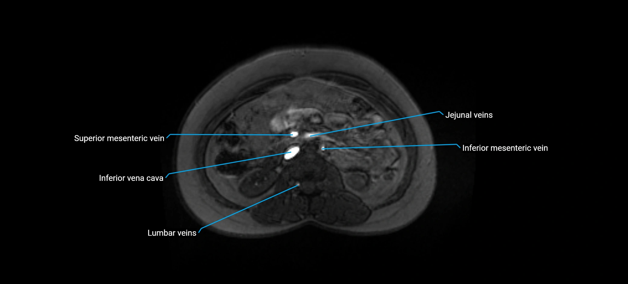 MRV abdomen pelvis & lower limb axial cross sectional anatomy labelled MRI image 80 (1).webp